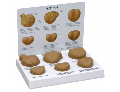 Model prostaty štádiá