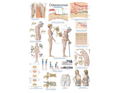 Obraz Osteoporóza 70x100cm