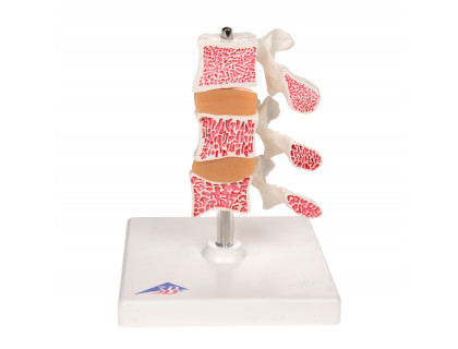 Model ľudských bedrových stavcov s osteoporózou 