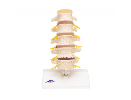 Model ľudskej bedrovej chrbtice s degenerovanými stavcami a medzistavcovými platničkami