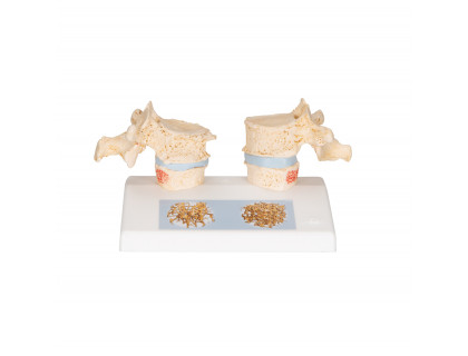 Model dvoch ľudských hrudných stavcov s osteoporózou