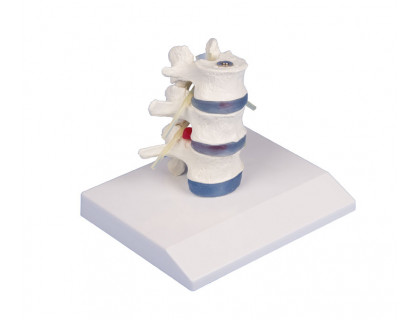 Model bedrovej chrbtice s vyskočenou platničkou s podstavcom