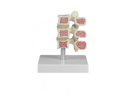 Model troch ľudských stavcov s osteoporózou