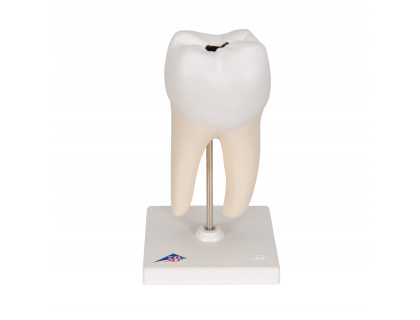 Model zub dolná dvojkoreňová stolička s kazom