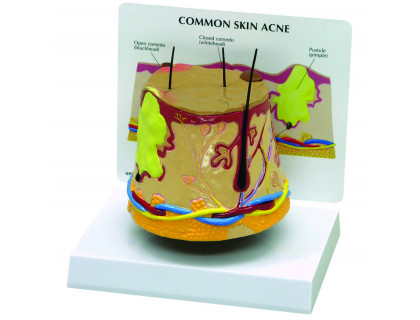 Model kožného akné