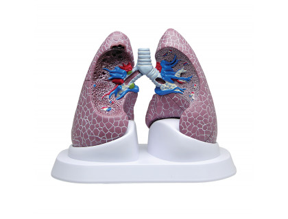 Model pľúc,patologické zmeny