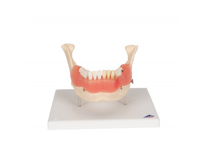 Model zubné ochorenia,21 častí