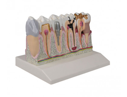 Model ochorenie zubov