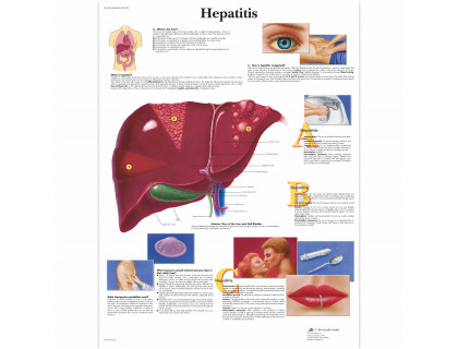 Obraz Hepatitída 50x67cm