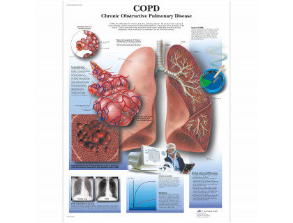 Obraz Chronická obštrukčná choroba pľúc 50x67cm
