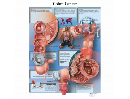 Obraz Rakovina hrubého čreva 50x67cm
