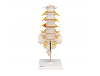 Model ľudskej bedrovej chrbtice s dorzolaterálnou vyskočenou medzistavcovou platničkou