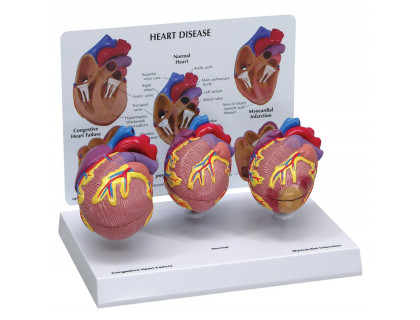 Model ochorenia ľudského srdca 