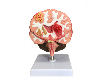 Model mozgovej mrtvice