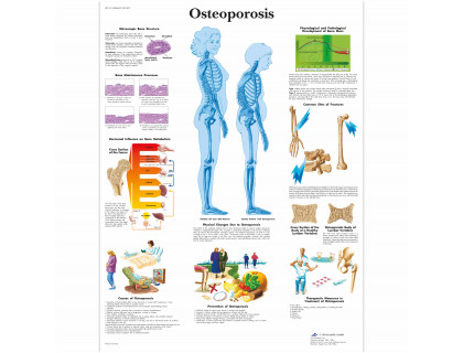 Obraz Osteoporóza 50x67cm