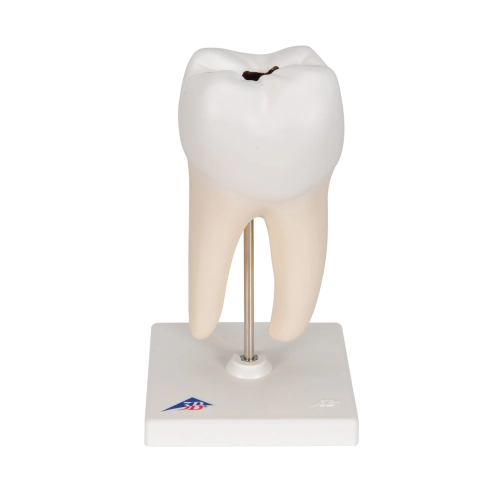 Model zub doln&aacute; dvojkoreňov&aacute; stolička s kazom