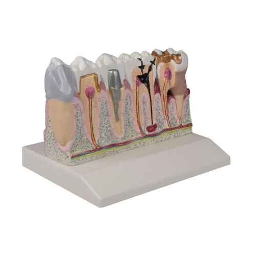 Model ochorenie zubov