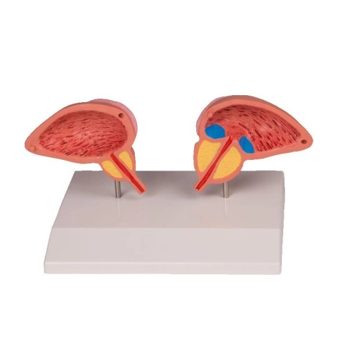 Model prostaty, 2-dielny